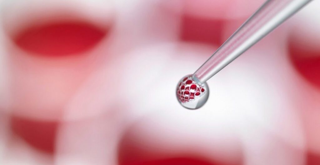 Cord Blood Sample Collection and Stem Cell Processing for Banking with Miracle Cord