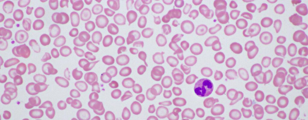 can cord blood cure thalassemia