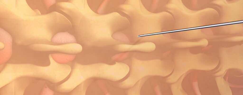 epidural alternatives for pain management during labor